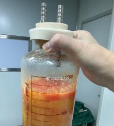 张家界水动力吸脂手术要做多久？